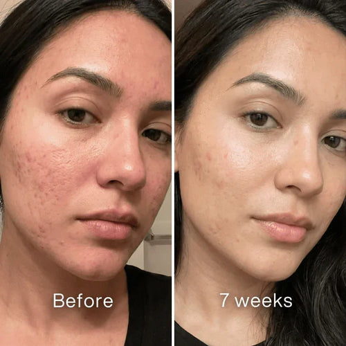 Advanced Acne Scar Rebuilding Stick