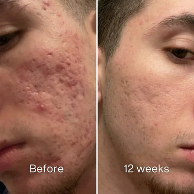 Advanced Acne Scar Rebuilding Stick